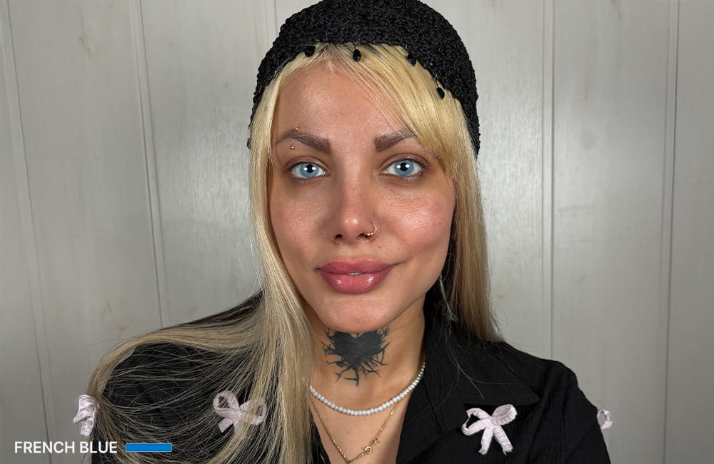 Female patient with French Blue corneal pigmentation result after permanent eye color change by keratopigmentation at Chromatic Eyes