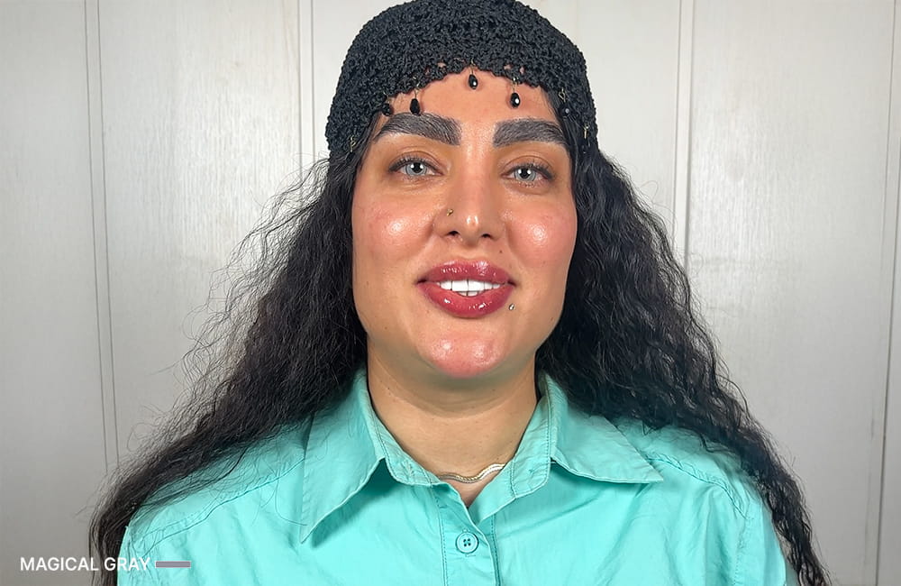 Iranian female patient with Magical Gray corneal pigmentation result after permanent eye color change by keratopigmentation at Chromatic Eyes