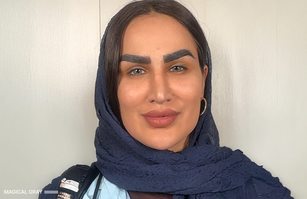 Iranian female patient with Magical Gray corneal pigmentation result after permanent eye color change by keratopigmentation at Chromatic Eyes