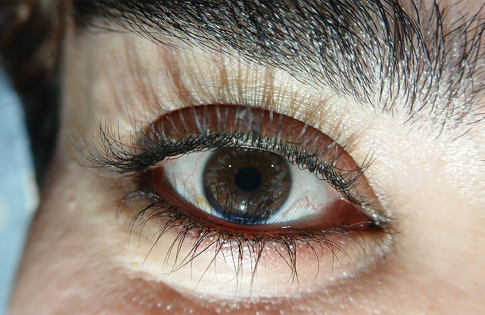 Iranian female patient showing early Hazel iris lightening after first laser depigmentation session at Chromatic Eyes Medical Center