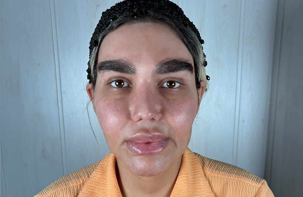 Female patient with natural dark brown eyes before permanent eye color change with keratopigmentation at Chromatic Eyes Medical Center