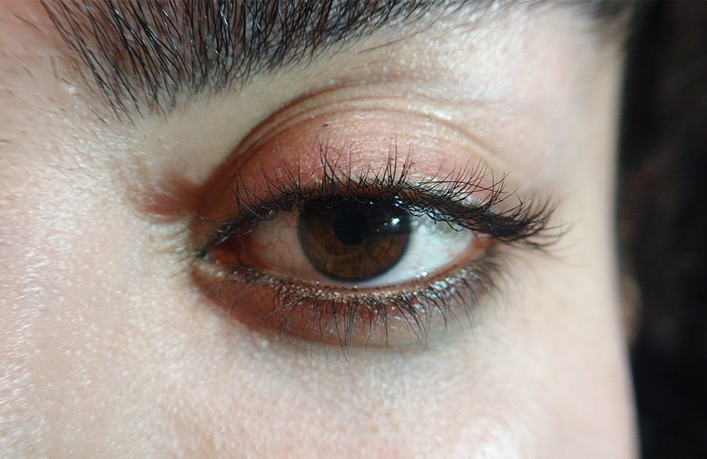 Iranian female patient with natural brown eyes before permanent laser eye color change at Chromatic Eyes Medical Center