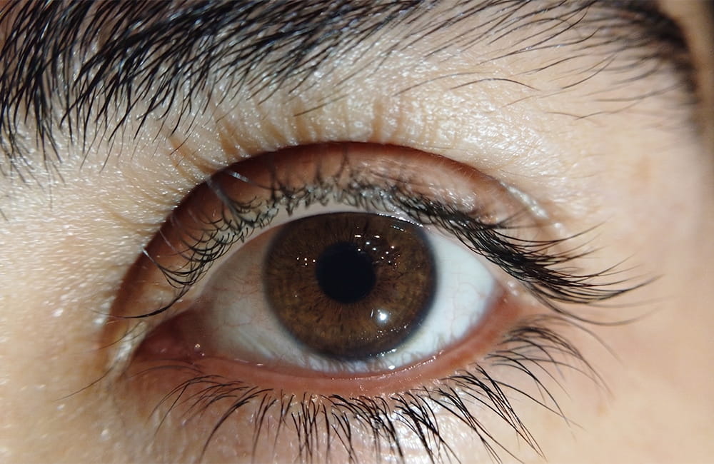 Iranian female patient with natural brown eyes before permanent laser eye color change at Chromatic Eyes Medical Center