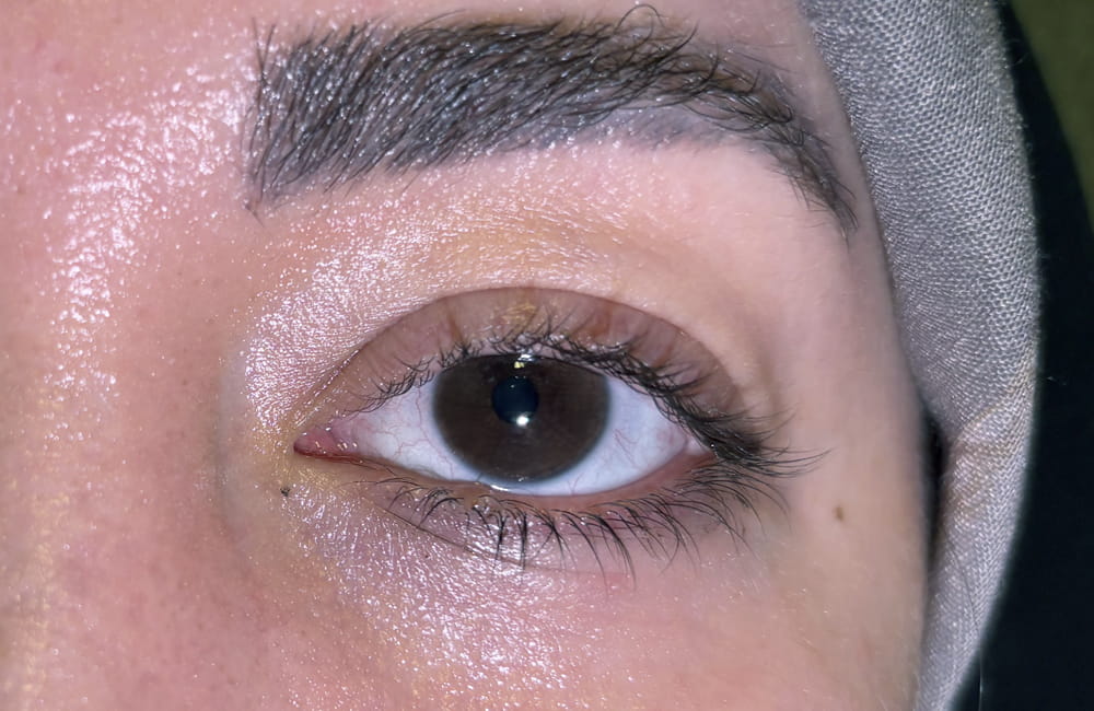 Iranian female patient with natural dark brown eyes before permanent laser eye color change at Chromatic Eyes