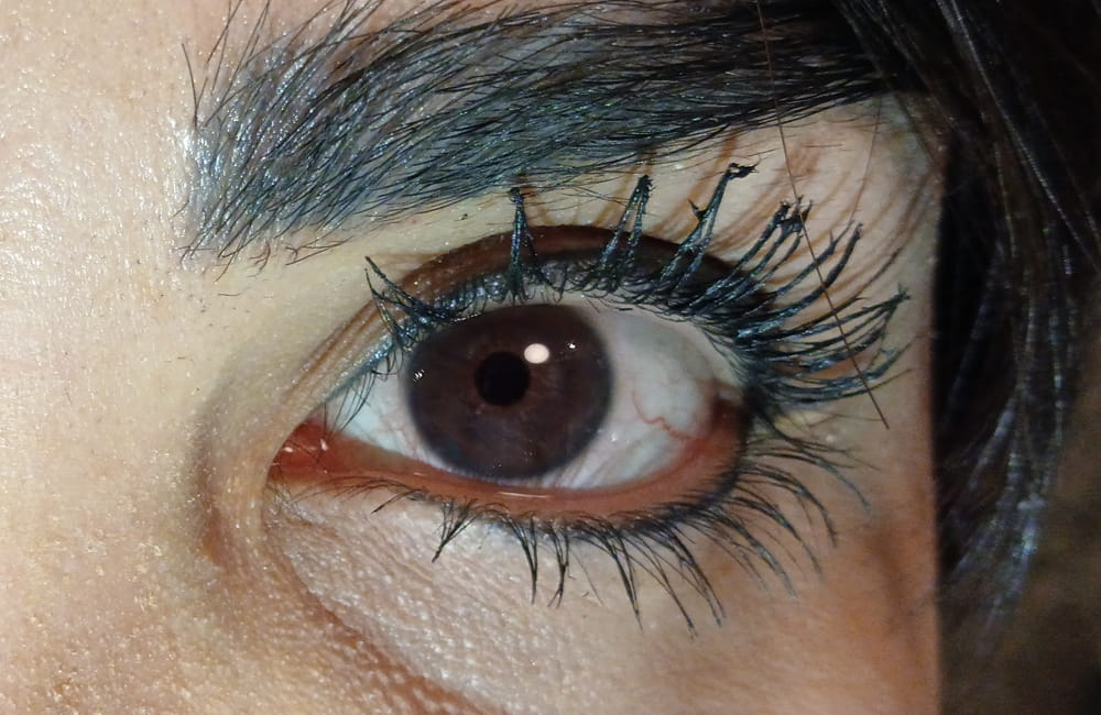 Female patient with natural dark brown eyes before permanent laser eye color change at Chromatic Eyes Medical Center, Vanak Square, Tehran, Iran