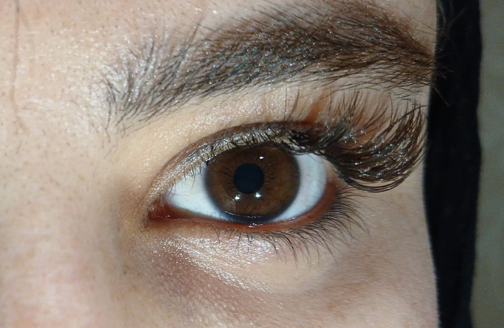 Female patient with natural dark brown eyes before permanent laser eye color change at Chromatic Eyes Medical Center