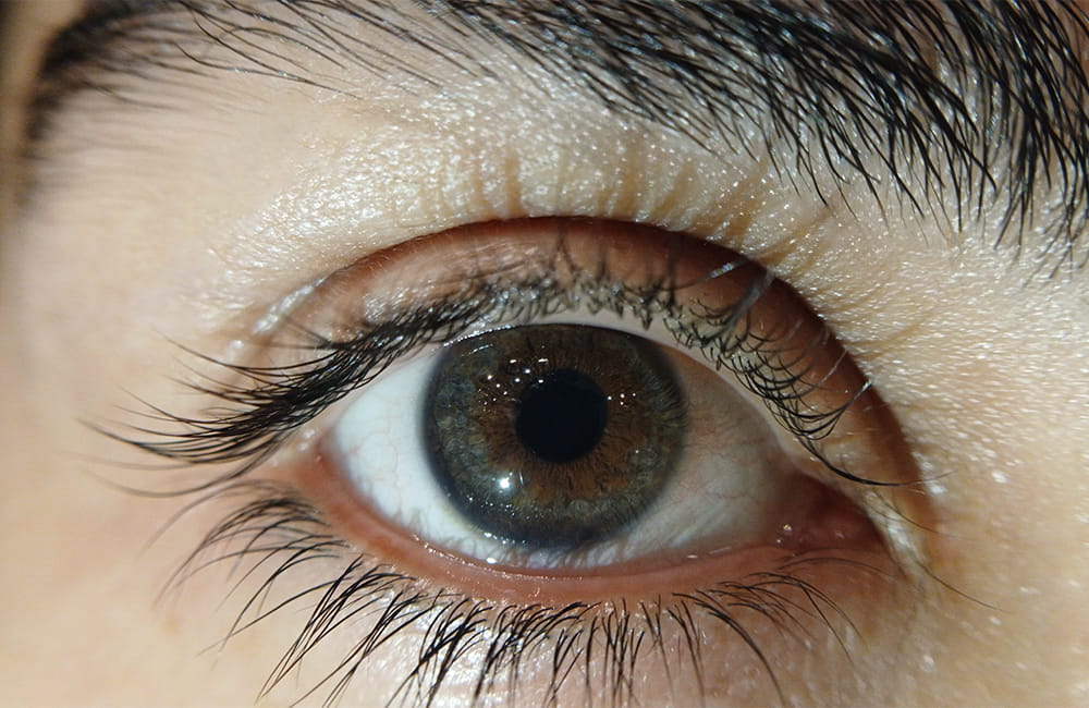 Iranian female patient with Blue-Gray eyes after permanent laser eye color change at Chromatic Eyes Medical Center