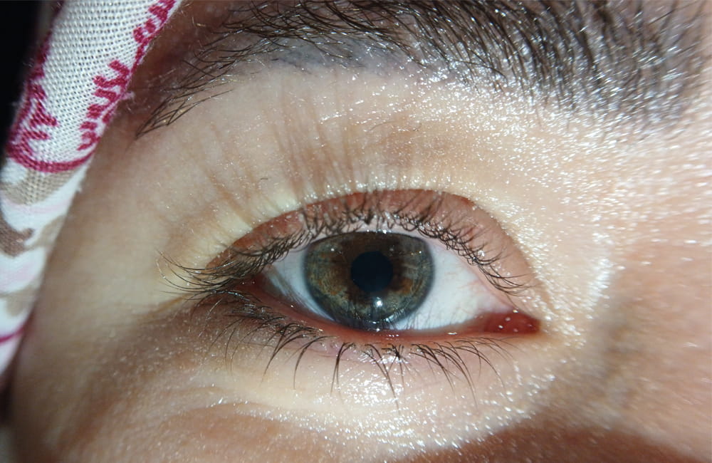 Iranian female patient with Blue-Gray eyes after permanent laser eye color change at Chromatic Eyes