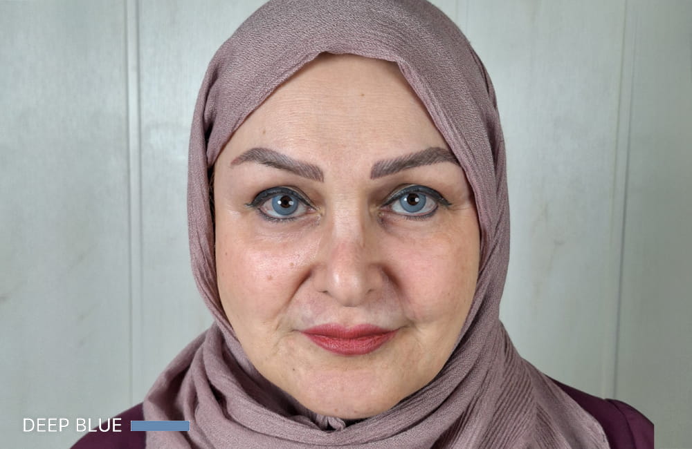 Female patient with Deep Blue eyes after permanent eye color change with keratopigmentation at Chromatic Eyes Medical Center
