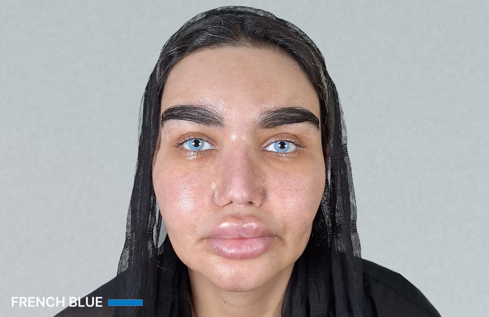 Female patient with French Blue eyes after permanent eye color change with keratopigmentation at Chromatic Eyes Medical Center