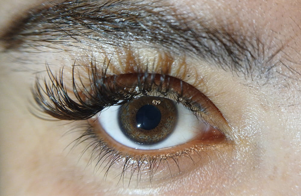 Female patient with golden brown eyes after permanent laser eye color change at Chromatic Eyes Medical Center