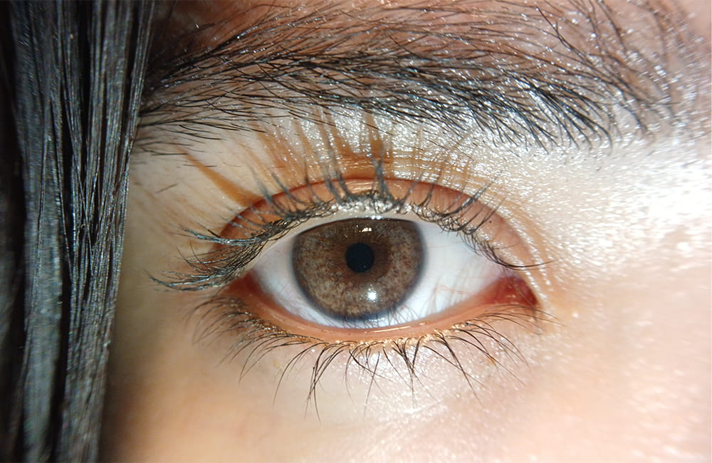Iranian female patient with Hazel eyes after permanent laser eye color change at Chromatic Eyes Medical Center