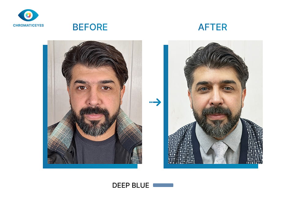 Brown eyes to Deep Blue before and after keratopigmentation