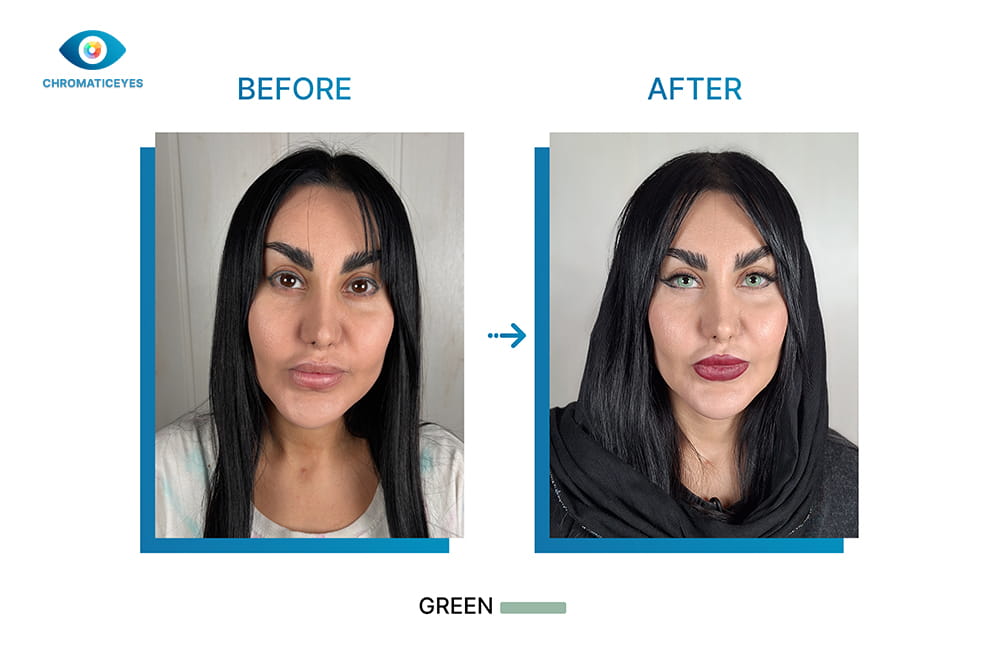 Brown eyes to green before and after keratopigmentation