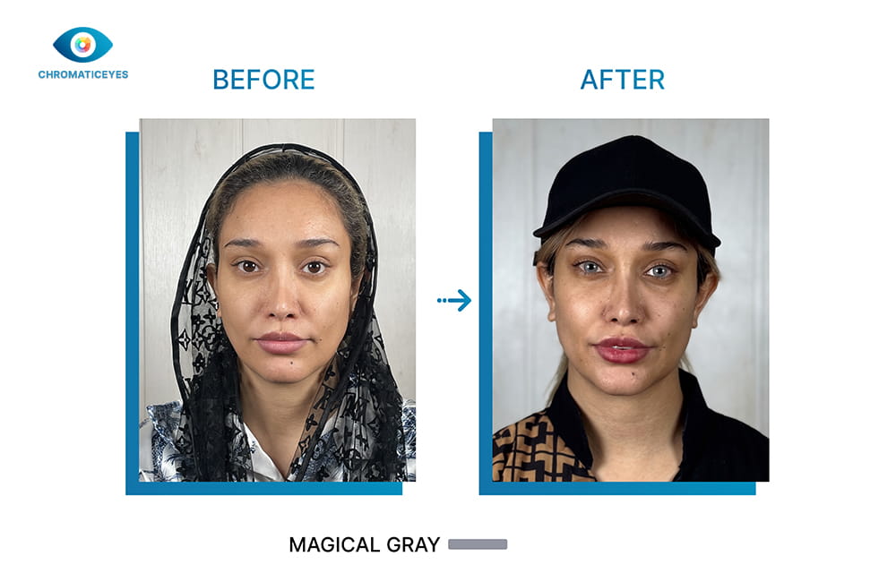 Brown eyes to Magical Gray before and after keratopigmentation
