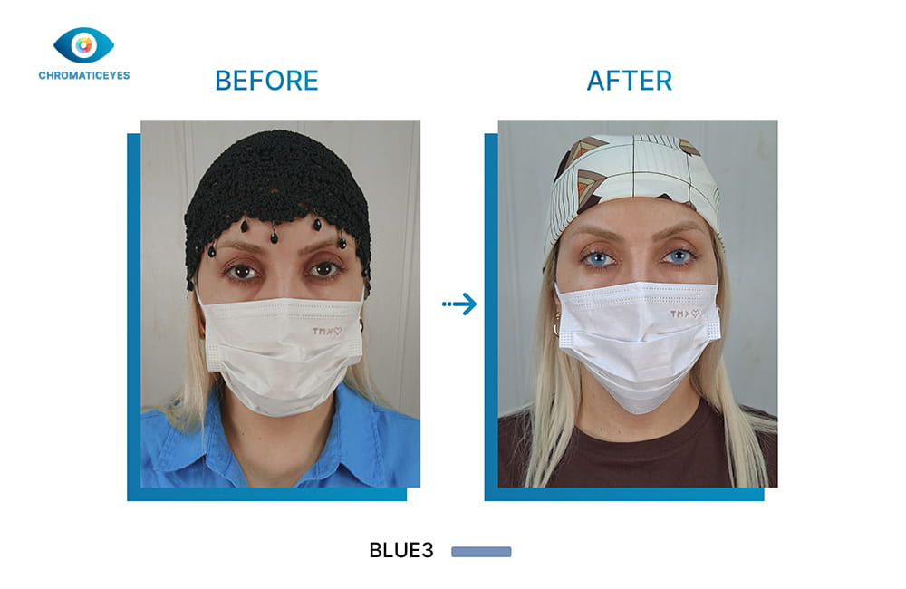 Brown to Blue 3 eyes before and after keratopigmentation