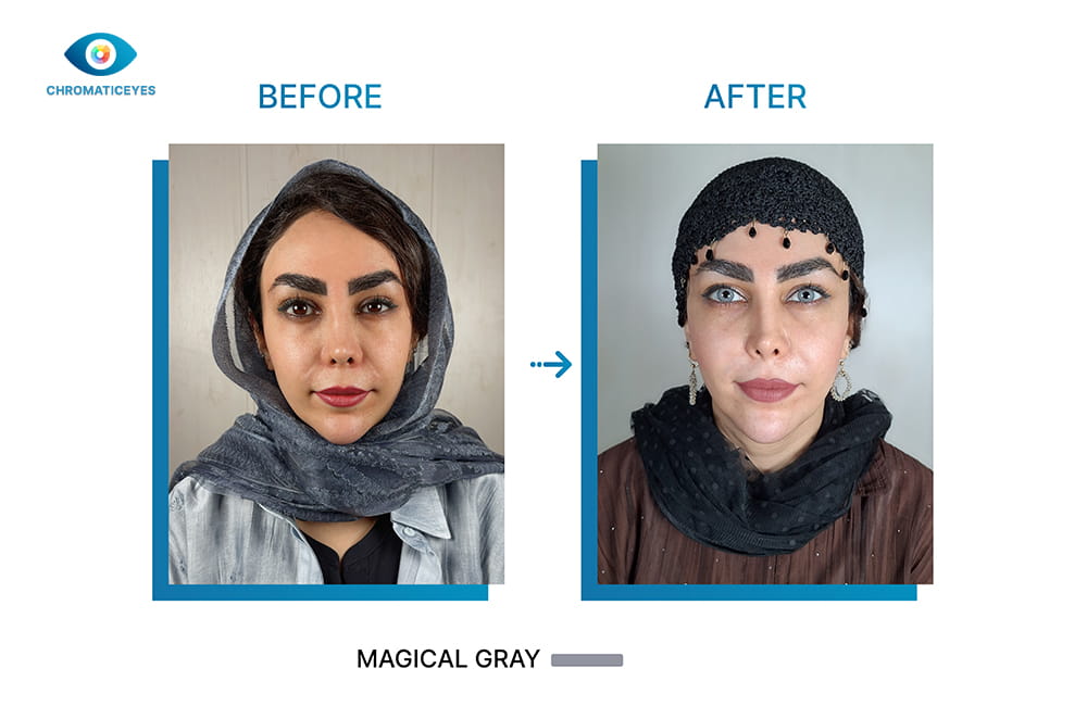 Brown to gray eye color change with Magical Gray keratopigmentation