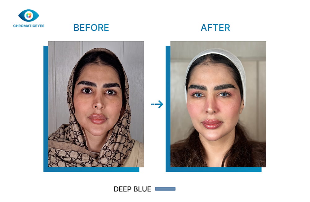 Dark brown eyes changed to Deep Blue before and after keratopigmentation