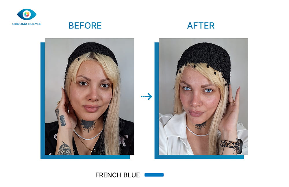 Dark brown eyes changed to French Blue before and after keratopigmentation