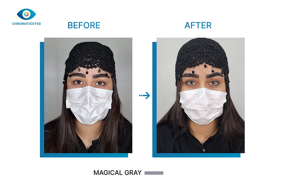 Dark brown eyes changed to Magical Gray before and after keratopigmentation
