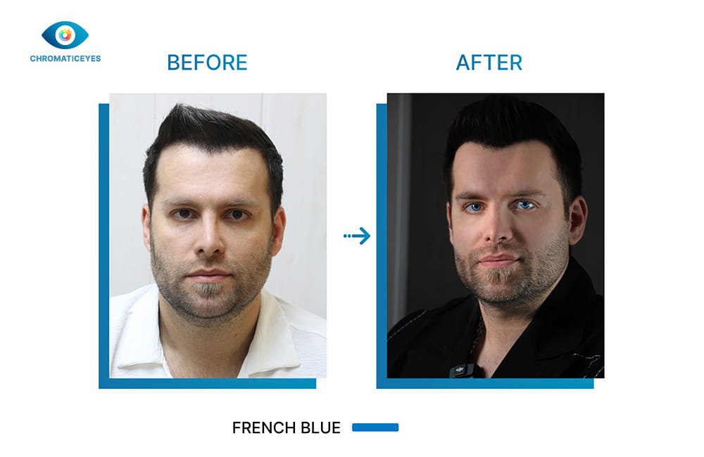 Male patient before and after French Blue eye color change