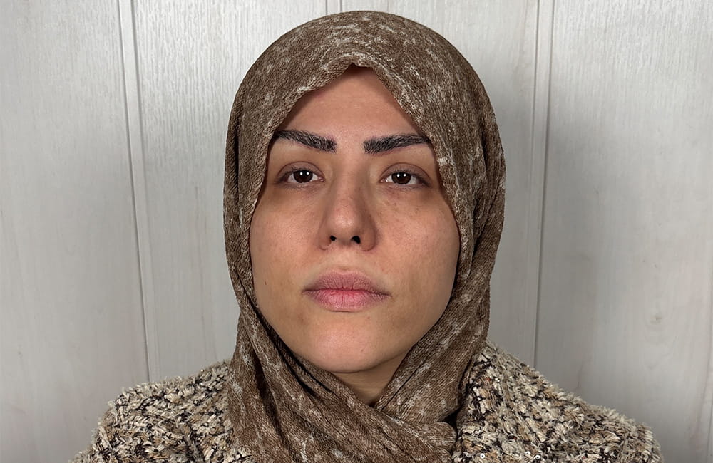 Female patient with natural dark brown eyes before Honey Gold eye color change by keratopigmentation at Chromatic Eyes Medical Center