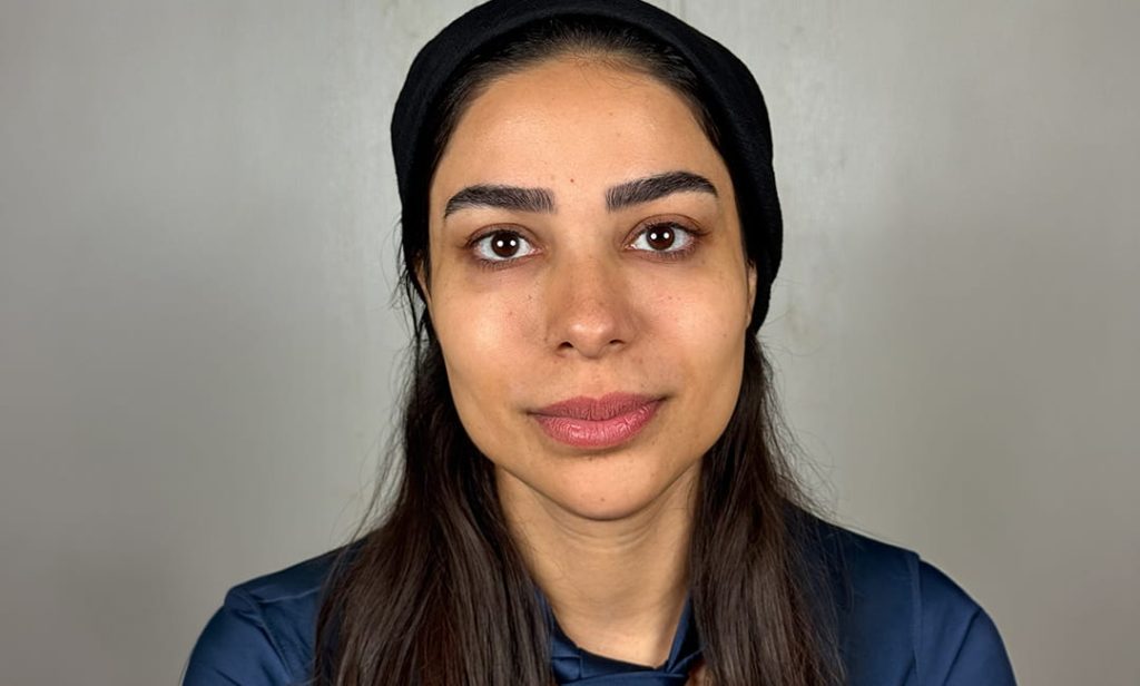 Female patient with natural dark brown eyes before Honey Gold eye color change by keratopigmentation at Chromatic Eyes Medical Center